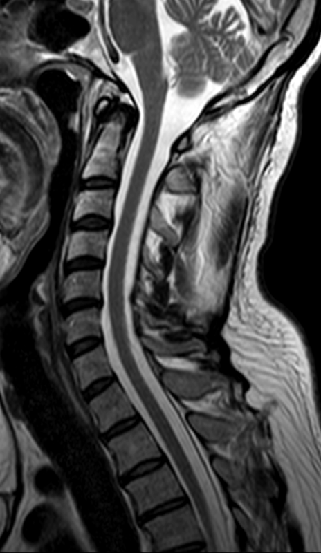 What is Flexion and Extension MRI for C-Spine? - M1 Imaging Center